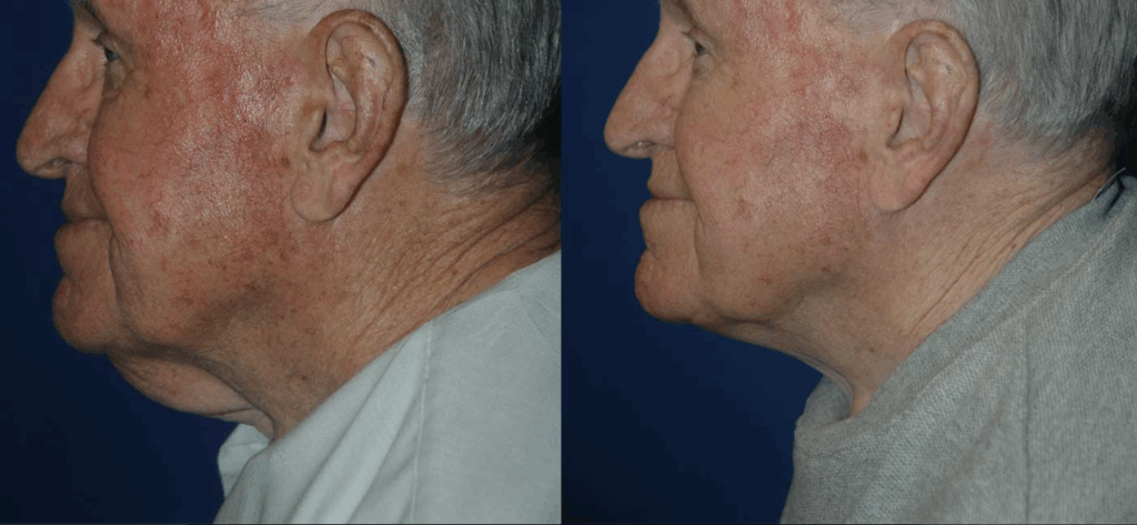 Before and after of an older man that has had neck lift surgery